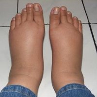 Отек ног после поездки